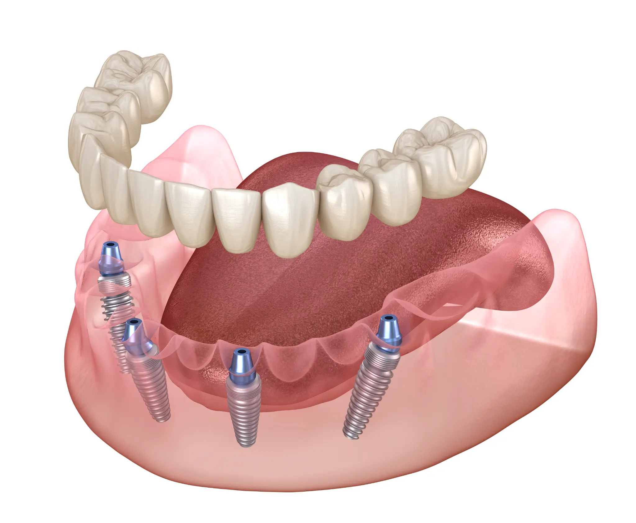 Illustration of a four-implant-supported full arch for an All-on-X restoration
