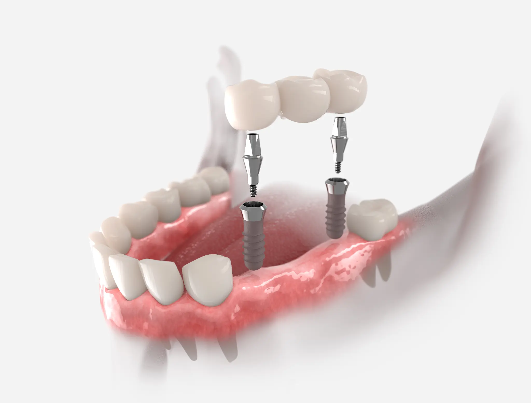 Three-dimensional model showing an implant-retained bridge