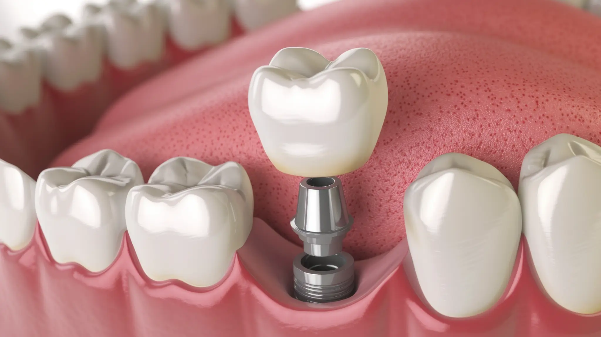 Three-dimensional model showing a single dental implant and crown
